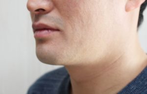 蓄膿症・鼻炎での口臭