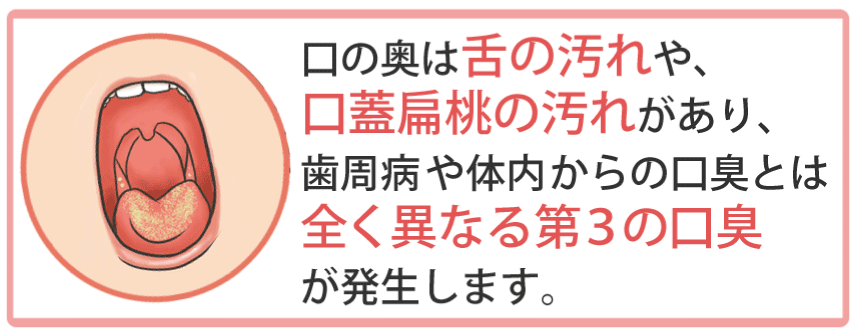 第３の口臭